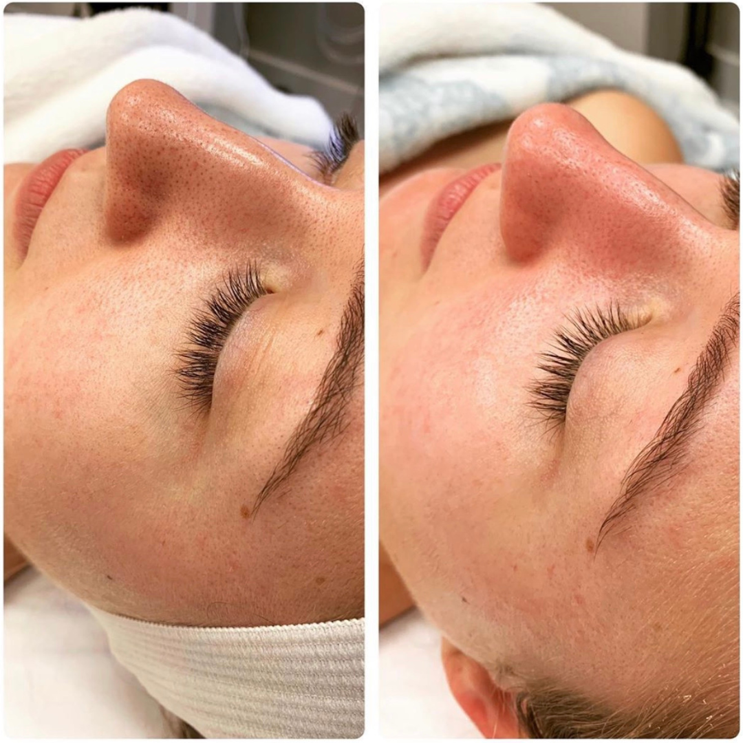 Client's cheek and nose before and after a Signature HydraFacial, showing clearer pores